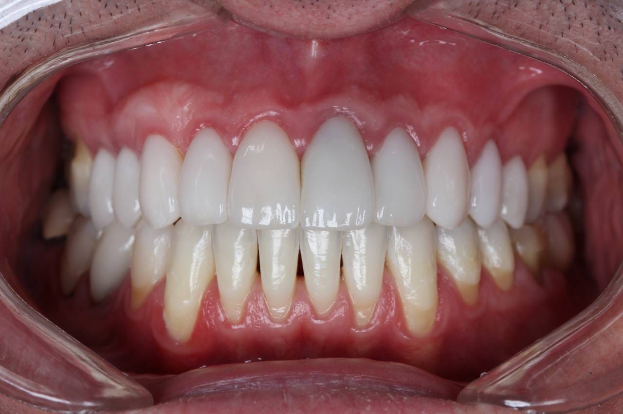 Imagem clínica de Recobrimento Radicular