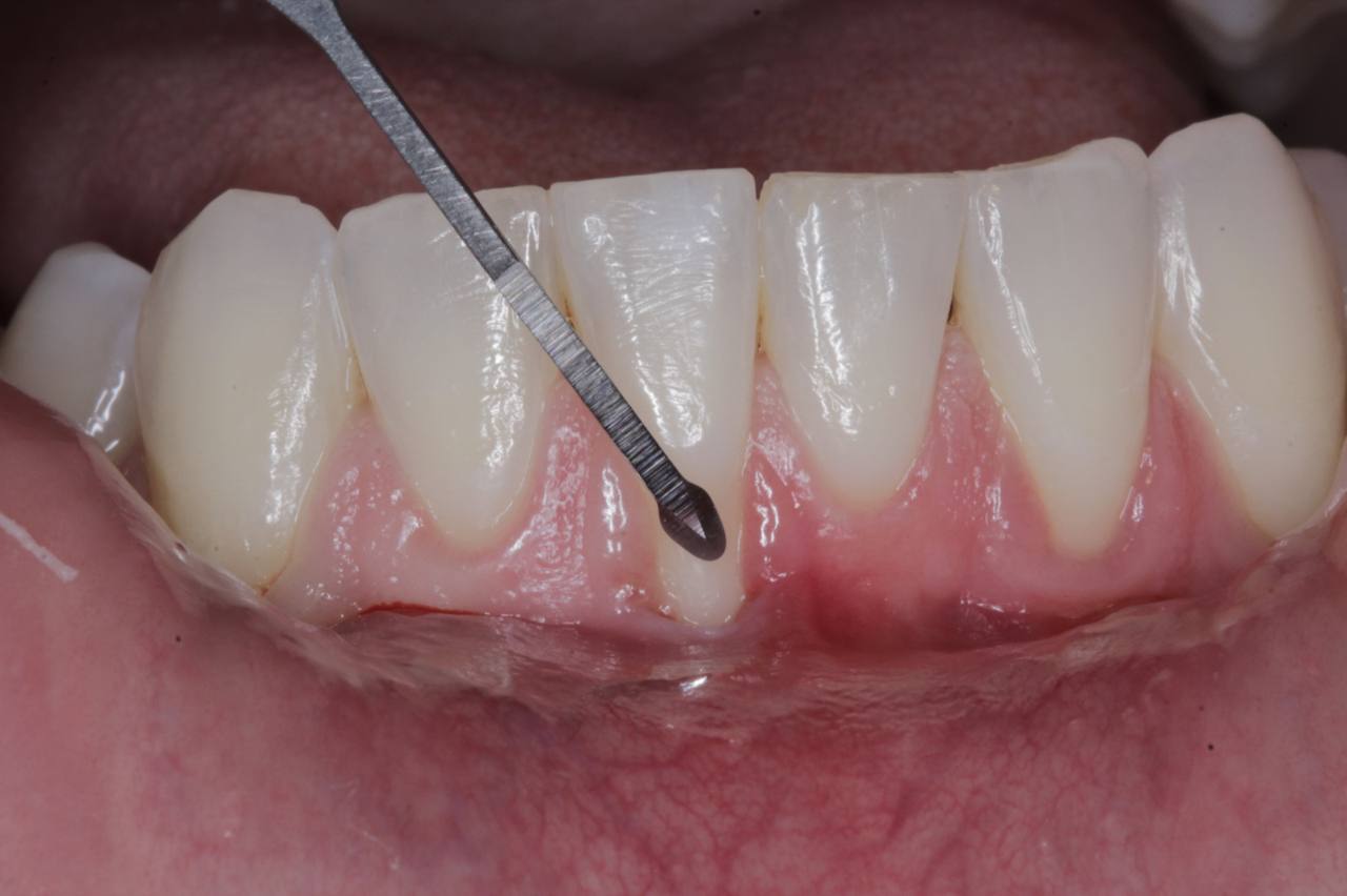 Sequência de Recobrimento Radicular 1