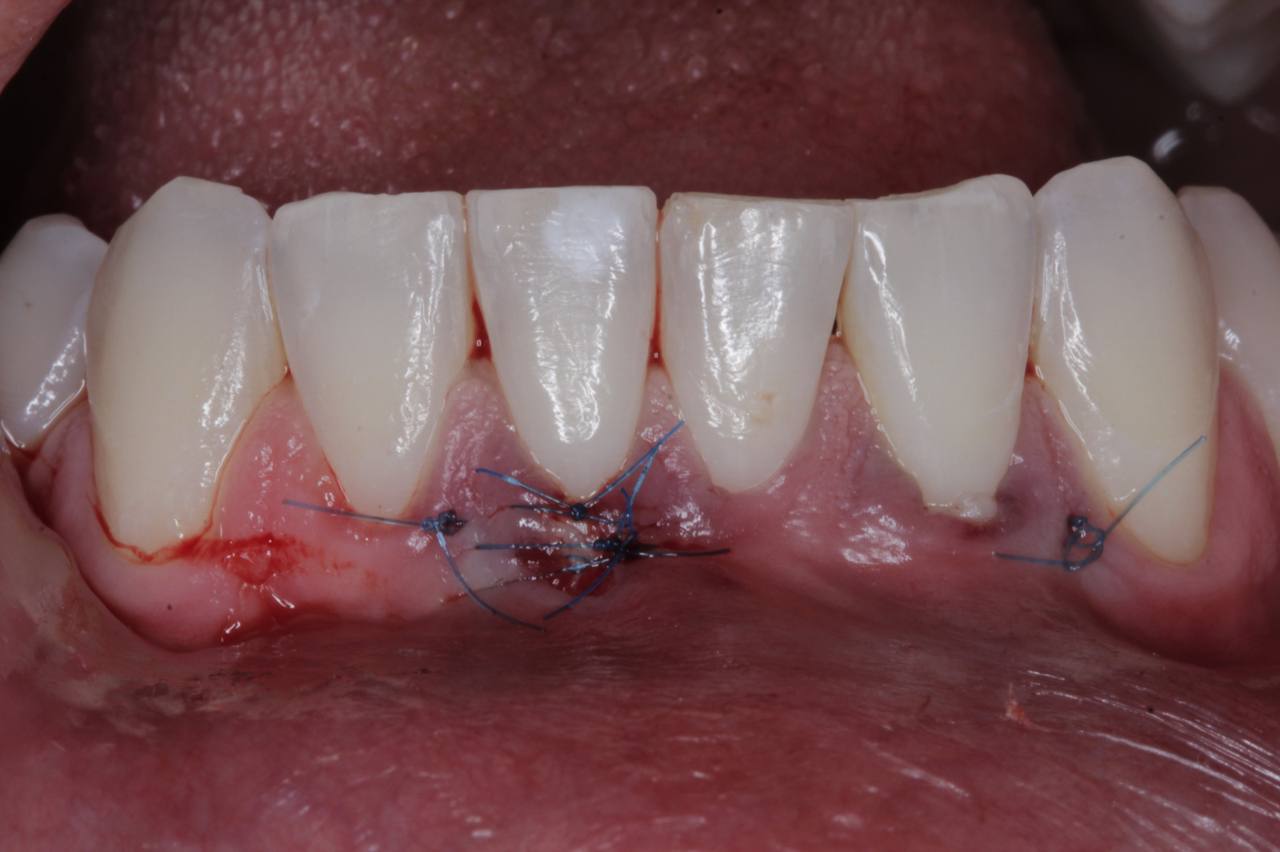 Sequência de Recobrimento Radicular 3