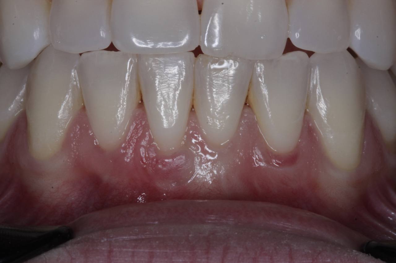 Sequência de Recobrimento Radicular 4